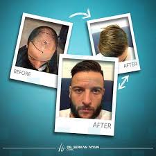 Hair Transplantation Sac
