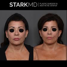 Ran Stark, MD, FACS‎‏ (@‏‎drstarkplasticsurgery‎‏) • صور ومقاطع فيديو على  Instagram