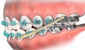 An underbite is when the lower jaw protrudes further out than the upper arch of teeth. Treating Underbites In Growing Kids Spring Orthodontics