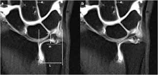 Schmerz in ulnardeviation dito, ev. Changes In The Morphology Of The Triangular Fibrocartilage Complex Tfcc On Magnetic Resonance Arthrography Related To Disruption Of Ulnar Foveal Attachment Springerlink