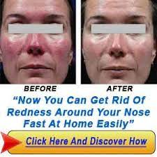 Paula's choice calm redness relief. How To Get Rid Of Redness Around Nose 7 Simple Ways Rosacea Diet Acne Rosacea Rosacea