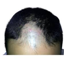 Acupuncture reduces hair loss and promotes hair regrowth for patients with alopecia (baldness). Acupuncture Therapy For Hair Regrowth In Sector 18 Noida Looks Forever Hair And Skin Aesthetic Clinic Id 19126657791