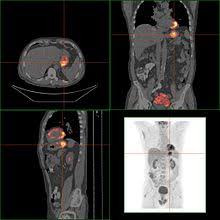 Gastritis Wikipedia