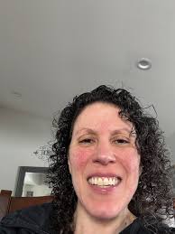 Starting ocrevus treatment for multiple sclerosis