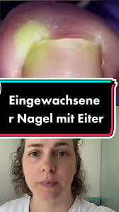 Eingewachsener Nagel Entfernen Mit Eiter