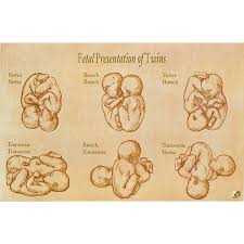 Transverse Twins Presentation Usdchfchart Com