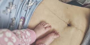 When you have diastasis recti, you'll likely see a bulge in your belly. Diastasis Recti Causes Symptoms And How To Treat It