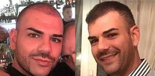 Pin By Hairtransland On Https Hairtransland Com Hair Transplant Hair Transplant