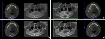 Scanner cone beam fractures mandibulaires focalisées