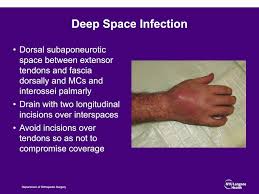 Image result for phlegmon of hand)