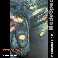 Check spelling or type a new query. Medespace Net Phototheque Chancre Mou