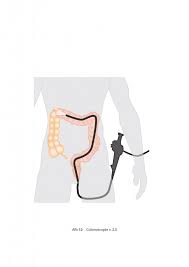 Een darmonderzoek of coloscopie, niet iets waar je op zit te wachten. Coloscopie Maag Lever Darm Stichting