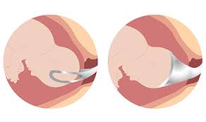 Image result for Forceps Assisted Delivery