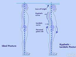 Children may not need to be treated. The Importance Of Reversal Of Cervical And Lumbar Lordosis Youmemindbody