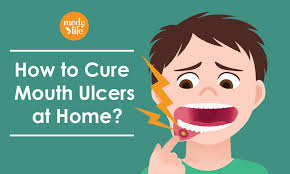Fed Up With Mouth Sores Try These Home Remedies For Mouth Ulcers