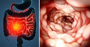 Deoarece inflamatia poate fi transmurala iar fistulizarea este frecventa, este posibila. Boala Crohn Cauzele Aparitiei Diagnostic Investigatii Tratament