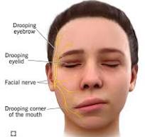 Bell's Palsy: What It Is, Causes, Symptoms & Treatment