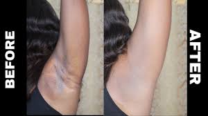 Maybe you would like to learn more about one of these? How To Get Rid Of Dark Armpits The Guardian Nigeria News Nigeria And World News Guardian Life The Guardian Nigeria News Nigeria And World News