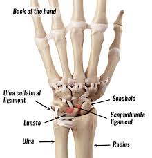 Tfcc Tear Sportsinjuryclinic Net Hand Therapy Bones And Muscles Scapholunate Ligament