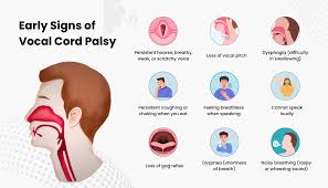 Image result for Vocal Cord Dysfunction