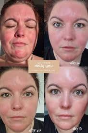 Meet Rachel. For years, she struggled with rosacea. Every cream, every  serum, every product burned her skin. She felt embarrassed and scared to  try anything new. Makeup? Out of the question. Then
