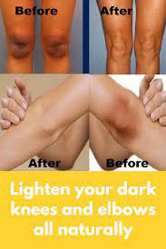 Press the lemon against the knee or elbow with dark spots. Lighten Your Dark Knees And Elbows All Naturally Today I Will Share How You Can Lighten Dark Knees And Elbows In Dark Elbows Skin Lightening Diy How To Lighten