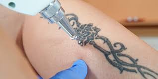 Not knowing which tattoo ink, how deep or how much was used, makes it impossible for the physician to predict the degree of removal on any given tattoo. What You Need To Know About Getting A Tattoo Removed H2ocean