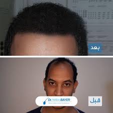 قبل وبعد زراعة الشعر Incoming Call Screenshot