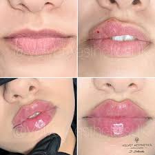 Depending on the area being treated, the treatment usually takes between 20 and 30 minutes, and clients describe it as a tiny scratch as the needle goes in, with a slight stinging sensation as the filler is applied. Velvet Aesthetics Price List