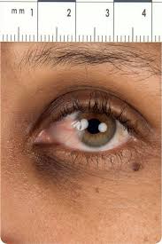 Image result for lesion sclera