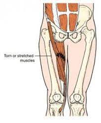 It adducts, internally rotates and flexes the femur. Groin Strain Physiotherapy Treatment Metro Physio