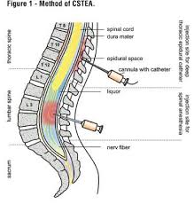 Epidural Vs Spinal Anesthesia Epidural Headache Is Not