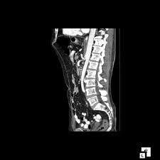 Median Arcuate Ligament Syndrome Coeliac Artery Compression Syndrome Dunbar Syndrome Upper Abdominal Angina Secondary To Syndrome Stenosis Celiac Artery