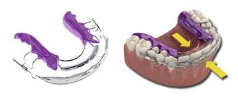The inman aligner is a removable, simple appliance which may safely and quickly straighten and align the front six lower/upper front teeth. Inman Aligner Kenilworth Il Evanston Il Glenview Il Art Carpenter Dds Ltd