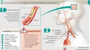 Appelez le 15 dès l'apparition brutale des signes suivants chez vous même ou chez l'un de vos proches : Pourquoi Hommes Et Femmes Ne Sont Pas Egaux Face Aux Avc