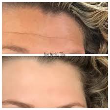 We did not find results for: Botox Before And After My Botox Experience