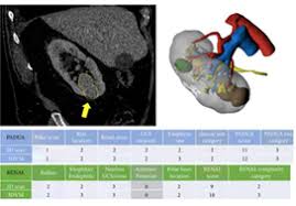 Scoring system for renal cancer: Nephrometry Score Archives Bjui