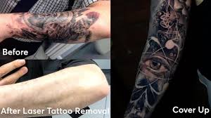 From laser to skin grafts, these are the pricey and how does laser tattoo removal work? Tattoo Removal Before And After Ink Infection Youtube