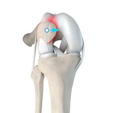 Image result for Patella Tracking Assessment