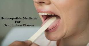 Homeopathic Treatment For Oral Lichen Planus Homeo Expert