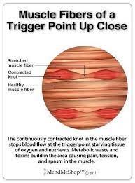 Https Www Facebook Com Fibrofighters2 Photos A 533316003386132 1073741827 445307032187030 869160343135028 Type 1 Trigger Points Massage Therapy Muscle Knots