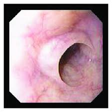 Van wikipedia, de gratis encyclopedie. Safety And Effectiveness Of Endoscopic Savary Gillaard Bougies Dilation In Moroccan Plummer Vinson Syndrome Patients