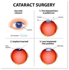 Image result for Cataract Extraction