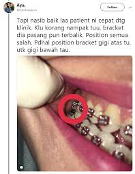Beras adalah komoditas makanan pokok yang tidak bisa dipisahkan dari masyarakat indonesia. Gadis Ini Pesan Elak Pasang Fake Braces Dekat Butik Kos Tak Sampai Rm1k Sebab Kesannya Mengerikan Hijabista