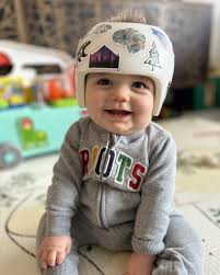 شعور الطفل عند ارتداء خوذة علاج الرأس المسطح