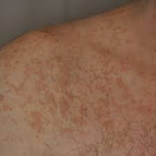 Prp can affect parts of your body or your entire body. Pityriasis Alba Doccheck Flexikon