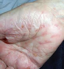 Prikkene forfaller tre år etter at du for eksempel har godtatt et forelegg på stedet. Rode Knopper Pa Huden Der Klor Er Det Fnat Fa Svaret Her Fnat Kur