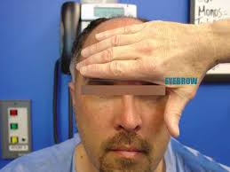 Because of our unique maxharvest technique these patients. Good Hair Line Design In Hair Transplantation Male Female Dr Caymaz Hair Transplant