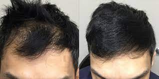 Prp malaysia | how much does it cost for prp treatment in malaysia. Prp For Hair Loss Treatment Info Price Reviews Nexus Clinic