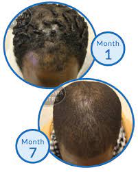 How to prevent hair loss with dreadlocks. Dreadlocks Hair Loss And Cultural Appropriation